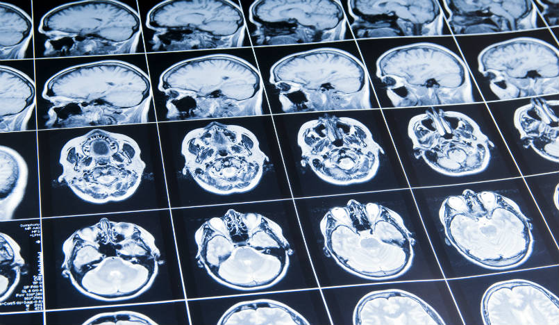 Study Reveals Potential Link Between Brain Trauma And Degenerative ...