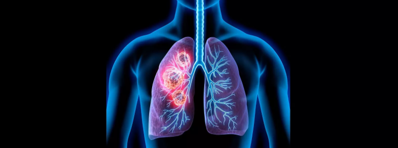 Lung Cancer Study Aims To Improve Treatment Efficiency Through Unique ...